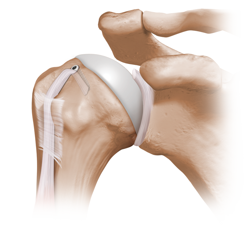 arisさま専用 Arthrex - Proximal Tenodesis Implant System (Includes